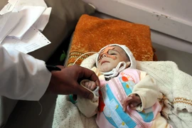 Trẻ em Yemen bị suy dinh dưỡng điều trị tại bệnh viện ở Sanaa. (Nguồn: THX/TTXVN)