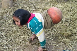 Nghị lực tuyệt vời của "cô bé bóng rổ" phải cắt bỏ đôi chân