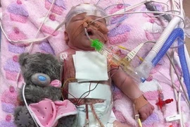 Bé Chanel phải phẫu thuật tim chỉ vài phút sau khi sinh. (Nguồn: Daily Mail)