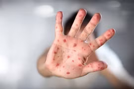 Lào phát hiện trường hợp mắc bệnh đậu mùa khỉ đầu tiên