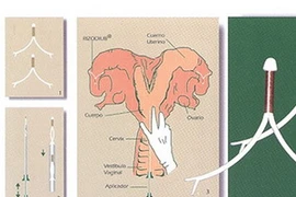 Thiết bị tránh thai cho bò. (Nguồn: pergaminovirtual)
