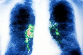 Hình ảnh viêm phổi cấp tính do Legionella.(Nguồn: suckhoedoisong.vn).