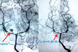 Túi phình mạch máu não trước và sau can thiệp. Ảnh minh họa (Nguồn: Bệnh viện Nhi Đồng 2)