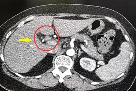 Hình ảnh chụp CT về ca bệnh. (Ảnh: Chanh Đa/TTXVN)