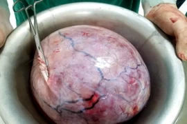Khối u được lấy ra có đường kính 30cm, nặng 5,5 kg. (Nguồn: Sở Y tế tỉnh Yên Bái)