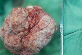 Khối u xơ nặng 4kg. (Ảnh: Thanh Sang/TTXVN)