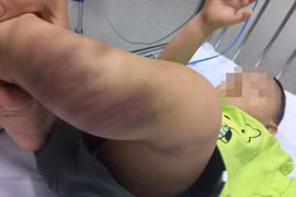 Một bé trai 1 tuổi nghi bị bạo hành, gây thương tích nghiêm trọng 