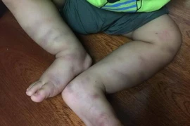 Bé trai khoảng 1 tuổi nghi bị bạo hành. (Nguồn: Bệnh viện Nhi Trung ương)