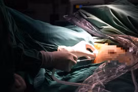 Bác sỹ tiến hành mổ nội soi một lỗ cho bệnh nhân. (Nguồn: Bệnh viện Nội tiết Trung ương)