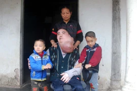 Hoàn cảnh khó khăn của người đàn ông có khối u khổng lồ trên mặt