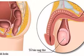 Dấu hiệu ung thư tinh hoàn.
