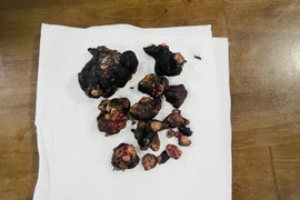 Khối sỏi san hô khủng có kích thước 8cm trong thận của bệnh nhân. (Ảnh: Lê Xuân/TTXVN)