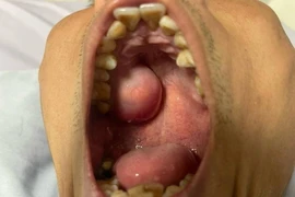 Phú Thọ: Bệnh viện huyện phẫu thuật thành công một ca bị u vòm miệng hiếm gặp