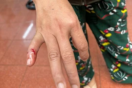 Vết thương vì chó dại cắn. (Nguồn: Báo Sức khỏe & Đời sống)