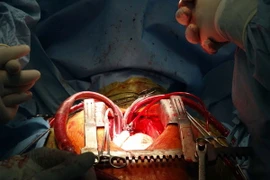 [Photo] Thực hiện ca cấy tim nhân tạo bán phần đầu tiên ở Việt Nam