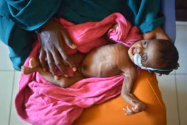 Chăm sóc trẻ em Somalia bị suy dinh dưỡng tại bệnh viện địa phương ở thị trấn Baidoa, thủ phủ vùng Bay, miền tây nam Somalia ngày 15/3. (Nguồn: AFP/TTXVN)