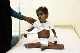 Điều trị cho một em bé bị suy dinh dưỡng ở thành phố cảng Hodeidah, Yemen ngày 5/11. (Nguồn: AFP/TTXVN)