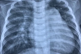 Phim chụp ngực bệnh nhi trước can thiệp. (Ảnh: PV/Vietnam+)