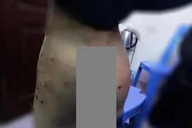 Lại một trường hợp nghi bố ruột ngược đãi con trai 9 tuổi ở Hà Nội