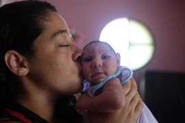 Một trẻ sơ sinh bị mắc căn bệnh đầu nhỏ do mẹ bị nhiễm virus Zika khi mang thai tại Rio de Janeiro ngày 4/2. (Nguồn: THX/TTXVN)