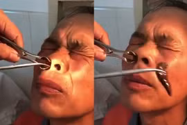 Hãi hùng với cảnh gắp con đỉa khổng lồ ra khỏi mũi người đàn ông