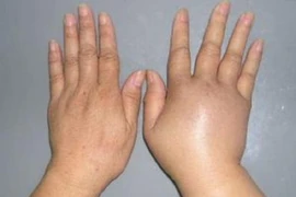 Chuyên gia hàng đầu thế giới chia sẻ cách điều trị bệnh phù bạch mạch