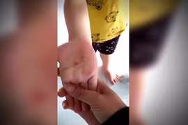 Thực hư việc cô giáo đâm vào tay bé trai 5 tuổi tại Bình Phước?