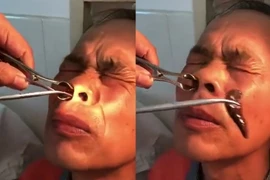 Hãi hùng với cảnh gắp con đỉa khổng lồ ra khỏi mũi người đàn ông