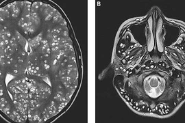 Kết quả chụp MRI cho thấy chàng trai có nhiều nang trong vỏ não (hình bên trái là các chấm trắng). Các tổn thương cũng được tìm thấy trong thân não và tiểu não của anh ta (nhìn bên phải). (Nguồn: dailymail.co.uk) 
