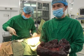 Khối u lá lách khủng được lấy trọn vẹn ra khỏi cơ thể bệnh nhân. (Ảnh: TTXVN phát)