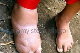 Một người bị bệnh phù chân voi. (Nguồn: alamy.com)