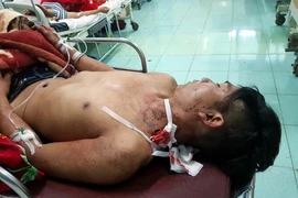 Bệnh nhân Điểu Khuê nhập viện trong tình trạng nguy kịch. (Ảnh: Bệnh viện cung cấp/TTXVN phát)