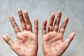 Một bệnh nhân bị mắc bệnh đậu mùa khỉ. (Ảnh: Shutterstock/TTXVN)