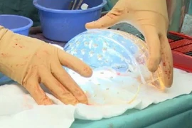 Hà Lan: Cấy ghép thành công hộp sọ 3D cho một phụ nữ