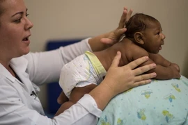 Một em bé bị mắc chứng đầu nhỏ do virus zika được điều trị tại bệnh viện ở Salvador, Brazil. (Nguồn: AFP/TTXVN)