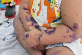 Đặc trưng của bệnh tay chân miệng là nổi mụn nước xung quanh miệng, tay và chân. (Ảnh: Đinh Hằng/TTXVN)