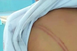 Nhiều vết bầm tím trên người cháu L.M.T được thầy cô giáo phát hiện. (Ảnh: TTXVN phát)