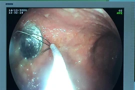 Nội soi gắp đồng xu ra khỏi cơ thể bé gái 4 tuổi. (Ảnh: TTXVN phát)