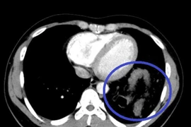 Tưởng hậu COVID-19, bệnh nhân đi khám phát hiện bị vỡ cơ hoành