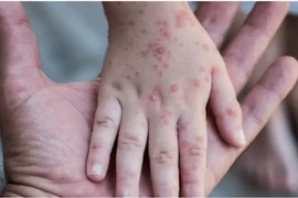 Mỹ và Anh tiếp tục ghi nhận nhiều ca mắc bệnh đậu mùa khỉ