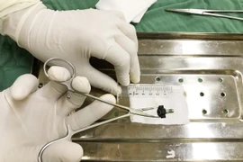 Bạc Liêu: Khẩn cấp lấy dị vật thành công trong âm đạo bé gái 8 tuổi