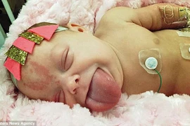 Bé Paisley Morrison-Johnson với chiếc lưỡi to do mắc hội chứng Beckwith Wiedemann - rối loạn tăng trưởng bẩm sinh. (Nguồn: Dailymail)