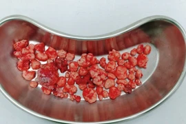 Số sỏi đươc lấy ra từ khớp háng. (Nguồn: Cand)