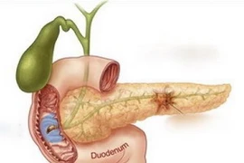 Triệu chứng của bệnh ung thư tụy. Ảnh minh họa. (Nguồn: ungthuvn.com)