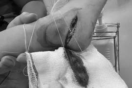 Bệnh nhi bị dao sắc nhọn đâm mạnh vào gót chân cắt rách một đoạn dài và sâu. (Ảnh: PV/Vietnam+)