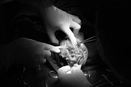 Các bác sỹ thực hiện ca phẫu thuật cho bệnh nhân. (Ảnh: PV/Vietnam+)