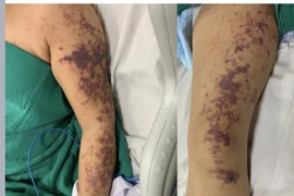 Hình ảnh cơ thể bệnh nhân mắc liên cầu lợn. (Ảnh: PV/Vietnam+)