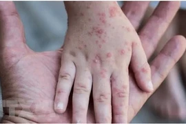 Ban đậu mùa khỉ nổi trên tay của một em nhỏ mắc bệnh ở nước ngoài. (Ảnh: Reuters/TTXVN)