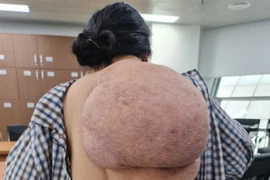 Khối u trên bả vai của bệnh nhân. (Ảnh: PV/Vietnam+)