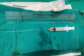 Hai con giun được lấy ra khỏi cơ thể của bệnh nhân. (Ảnh: PV/Vietnam+)